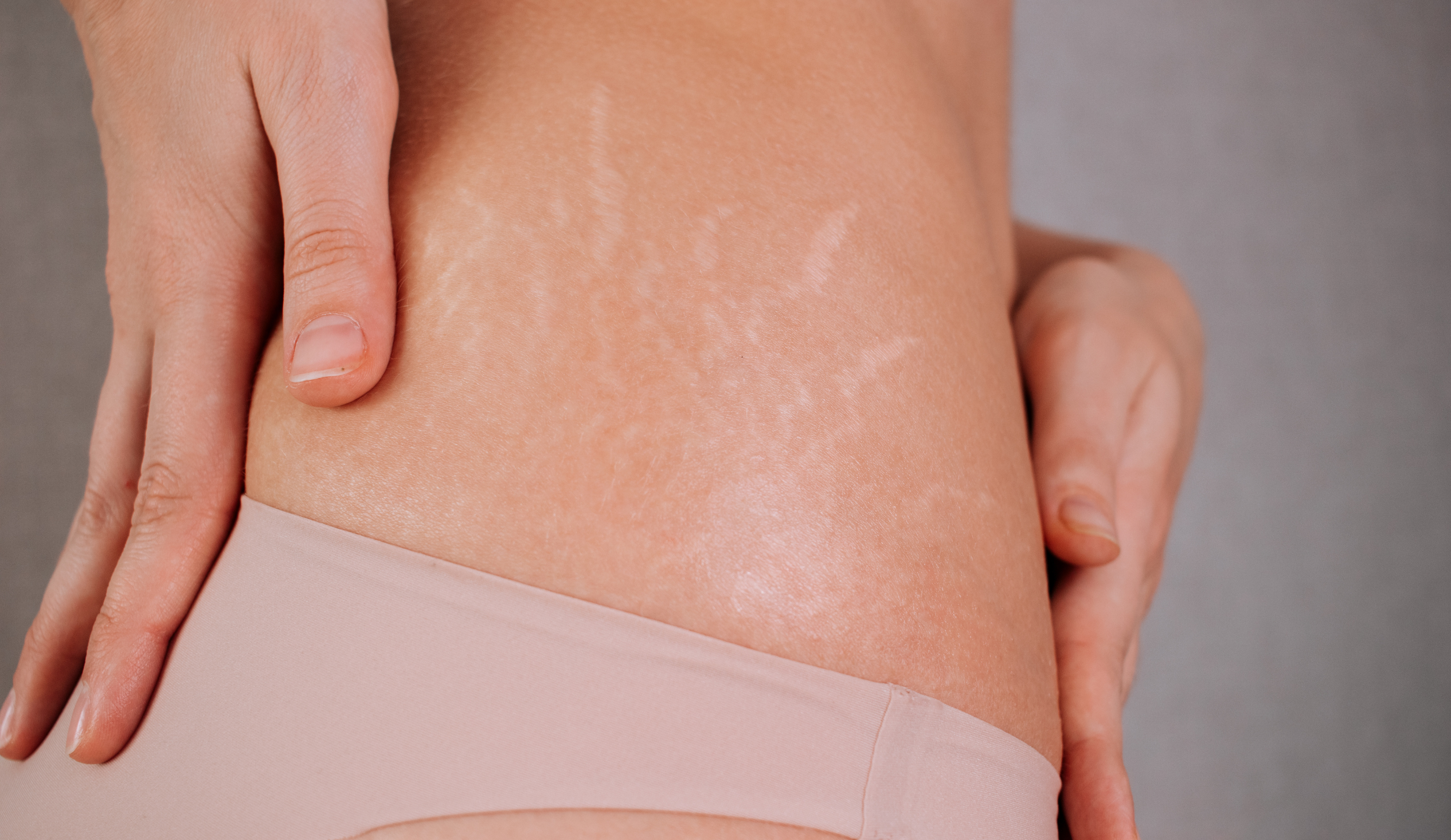 Inkless stretch mark therapy – Stretch marks