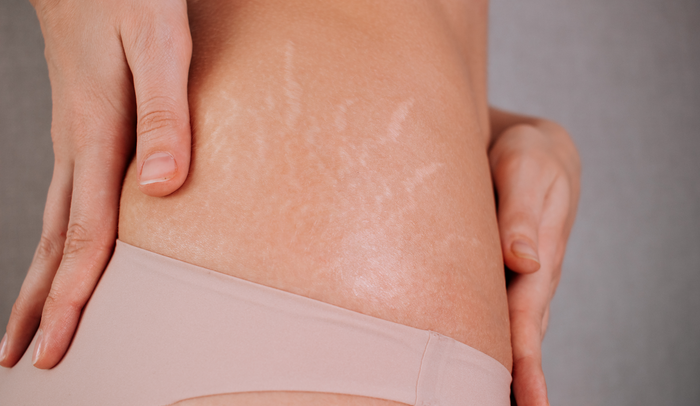 Inkless stretch mark therapy – Striae
